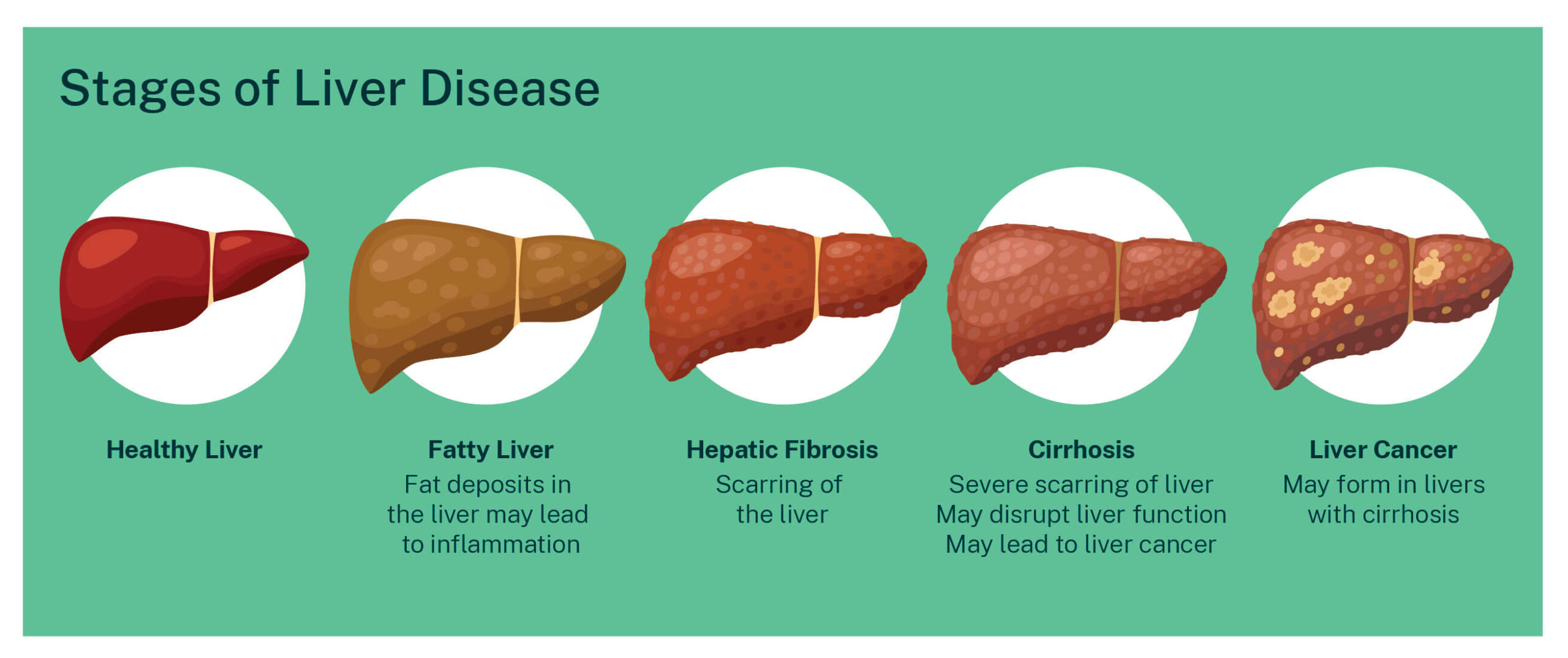 new research for liver cirrhosis